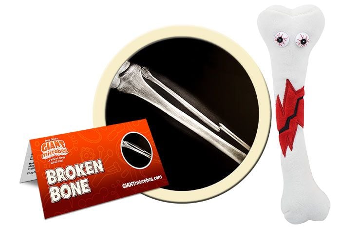Broken Bone