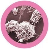 Breast Cancer (Malignant neoplasm)
