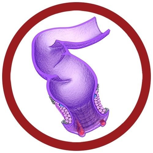 Hemorrhoid