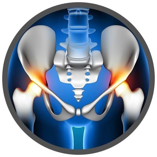 Hip Replacement