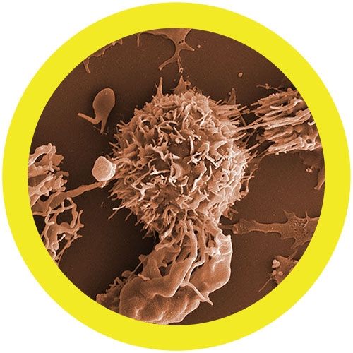 Leukemia